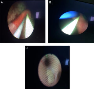 (A) Two guidewires, one for the passage of the ureteral access sheath and a safety wire entering the urethral meatus. (B) Safety wire and JJ catheter entering the urethral meatus. (C) Collecting system, middle calyceal stone and safety wire toward the upper calyx are evidenced.