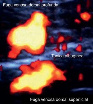 Fuga venosa dorsal profunda a túnica albugínea y fuga venosa dorsal superficial simultánea. El complejo fascia-túnica está claramente definido entre las 2 fugas.