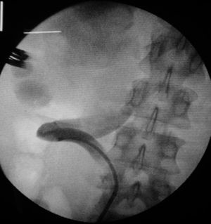 Tortuosidad ureteral proximal, imposibilita paso del instrumental endoscópico.