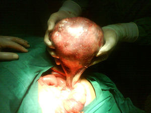 Resección de teratoma quístico que depende de trompa de Falopio y ovario izquierdos.