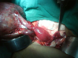 Órganos genitales internos femeninos (ovoteste derecho, útero y trompas de Falopio).