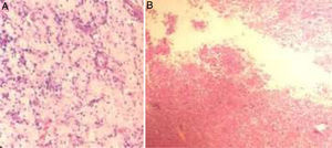 Hallazgos histopatológicos. A) Acúmulo de histiocitos espumosos. B) Granuloma con centro necrótico.