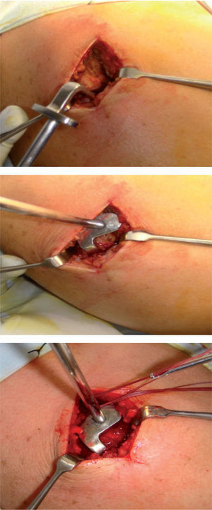 Una vez identificada la luxación acromioclavicular aguda, se reseca el menisco acromioclavicular y se hace introducción del reductor acromioclavicular, pasando entonces a la marcación de las dos perforaciones para el paso de las suturas coracoclaviculares a través de la clavícula. Una vez se tiene la reducción anatómica con el reductor acromioclavicular, se ligan las suturas coracoclaviculares con el sexto dedo artroscópico, sin riesgo de pérdida de la reducción y con gran facilidad.
