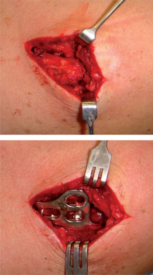 Reducción anatómica una vez retirado el reductor acromioclavicular y neutralización de las suturas coracoclaviculares con la placa gancho corta de 15mm de altura.