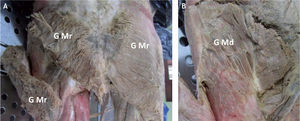 Imagen del glúteo medio en preparado anatómico. A: se muestra el músculo glúteo mayor (G Mr) con incisión a través de sus fibras para identificar por debajo las fibras musculares del glúteo medio (G Md). B: se aprecia la masa muscular del glúteo medio, su porción media y posterior con su inserción proximal en forma de abanico y sus fibras confluyendo distalmente para insertarse en el trocánter mayor.