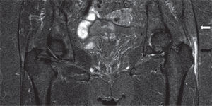 Resonancia magnética de pelvis, en proyección coronal. Bursitis trocantérica leve al lado derecho y mucho más notoria al lado izquierdo (flecha negra); la reacción inflamatoria está por dentro de la banda iliotibial (flecha blanca) y sobre la inserción de los tendones glúteos.