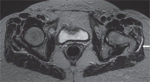 Proyección axial de caderas en resonancia magnética. Inflamación bursal en la cadera izquierda, por encima de la inserción de los tendones glúteos.