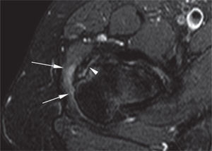 Resonancia magnética de cadera derecha en proyección axial. Bursitis trocantérica (flechas largas y delgadas) adyacente a unos cambios intratendinosos de tendinosis del glúteo menor (flecha corta y gruesa).