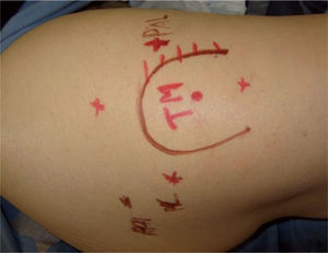 Trocánter mayor (TM), portal anterolateral (PAL), portal posterolateral (PPL) y los portales proximal y distal a la punta del trocánter.
