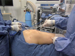 Al iniciar el procedimiento endoscópico, se introduce un trócar u obturador por el portal superior al trocánter y otro por el portal distal, para que sus puntas se encuentren en el espacio subcutáneo, encima de la banda iliotibial antes de introducir la lente.