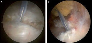 Imagen endoscópica que muestra el inicio del corte longitudinal proximal y distal de la banda iliotibial con punta de radiofrecuencia.