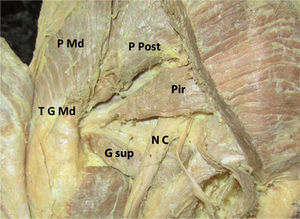 En este preparado anatómico se identifican la porción media (P Md) y posterior (P Post) del músculo glúteo medio con su tendón (T G Md) de inserción en el trocánter mayor, el músculo piriforme o piramidal (Pir) y su tendón insertándose en la parte posterior del trocánter mayor, el nervio ciático (N C) saliendo por debajo del músculo piramidal y el vientre múscular del geminus superior (G sup).
