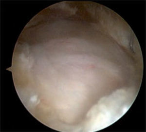 Imagen endoscópica final luego de seccionar la banda iliotibial longitudinal y transversalmente; luego de resecar los colgajos creados, se identifica un defecto con figura en rombo, a través del cual se identifica el trocánter mayor con la inserción de tendones glúteos.