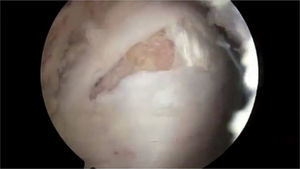 Imagen endoscópica de una rotura de espesor total del tendón del glúteo medio en su sitio de inserción en el trocánter mayor. Esta imagen es similar a las encontradas en las roturas del manguito rotador del hombro.