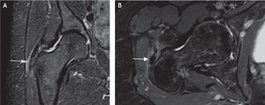 Resonancia magnética. A: proyección coronal que muestra una bursitis y una tendinosis del glúteo menor (flecha) con rotura parcial en el sitio de inserción en el trocánter mayor. B: proyección axial; se identifica la tendinosis de dicho tendón con rotura parcial.