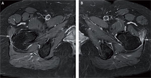 A: tendinosis del glúteo menor. B: rotura total del mismo tendón.