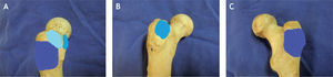 Se muestran las tres bursas subglúteas principales: la bursa subglúteo menor en la zona anterior, la bursa subglúteo medio en la parte superior y lateral, y la llamada bursa trocantérica, la más grande, en la cara lateral y posterior.
