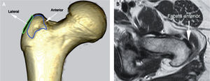 A: tomografía computarizada en proyección coronal; se señala la faceta anterior en azul y parte de la faceta lateral en verde. B: resonancia magnética en proyección axial; se muestra la faceta lateral con la inserción del tendón del glúteo menor.