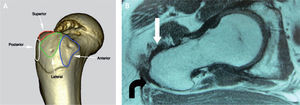 A: tomografía computarizada del fémur proximal; se demarcan las facetas del trocánter mayor. B: resonancia magnética en proyección axial; inserción del tendón del glúteo menor en la faceta anterior (flecha blanca) e inserción del tendón del glúteo medio en la faceta lateral (flecha negra).