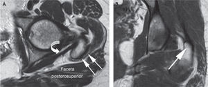 A: resonancia magnética en proyección axial; faceta posterosuperior con la inserción del tendón del glúteo medio (flechas blancas) y el tendón del músculo piramidal o piriforme en su trayecto para insertarse en la parte posterior del trocánter mayor (flecha curva). B: proyección coronal, la misma faceta con la inserción del tendón glúteo medio.