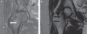 A: inserción del tendón del glúteo menor en el trocánter mayor, en proyección coronal de resonancia magnética; se marcan los vientres musculares del glúteo medio y menor. B: corte coronal más posterior; inserción del tendón del glúteo medio (flecha proximal) e inserción del músculo vasto lateral (flecha distal).