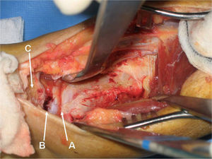 Visión del campo quirúrgico una vez rechazado el vientre muscular del flexor hallucis longus. A: articulación tibioastragalina. B: articulación subastragalina posterior. C: tuberosidad posterior del calcáneo.