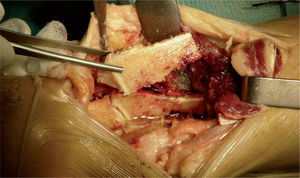 Imagen de la cuña ósea resecada de la cortical posterior de la tibia.