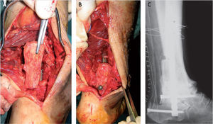 Visión clínica y radiológica de la artrodesis posterior. A: colocación del injerto tibial. B: visión clínica de la artrodesis. C: radiografía postoperatoria de la artrodesis tibioastragalocalcánea por vía posterior.
