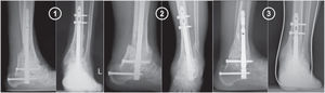 Diferentes casos clínicos con una artrodesis tibioastragalocalcánea realizada mediante esta técnica quirúrgica, donde se aprecia la correcta consolidación y alineación.