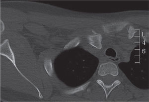 Corte axial de tomografía computarizada de la articulación esternoclavicular derecha. Se evidencia la pérdida de la relación articular por el desplazamiento posterior del extremo proximal de la clavícula.