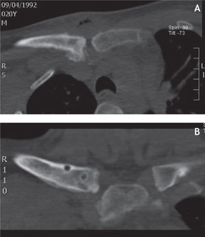 Tomografía computarizada. Imágenes de la articulación esternoclavicular derecha tras retirar el material de osteosíntesis.