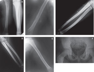 Radiografías de piernas, fémur, antebrazo y pelvis. Se observan imágenes radioopacas características de la enfermedad de Camurati-Engelmann.