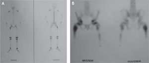 Informe de gammagrafía ósea que muestra zonas de hipercaptación evidente en las metáfisis femorales proximales, especialmente la derecha, antes del episodio de fractura subtrocantérica.