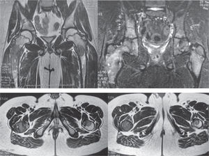 Resonancia magnética de pelvis; se observan imágenes hipointensas en metáfisis femoral bilateral.