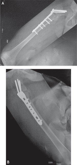Radiografías posquirúrgicas de fémur en proyecciones anteroposterior y lateral. Se observa osteosíntesis con placa LCP de fémur proximal.