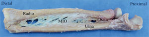 Disección profunda del antebrazo mostrando la anatomía macroscópica de la membrana interósea.