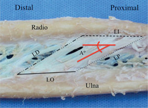 Detalle de la membrana interósea que muestra las mediciones realizadas en la banda central. Se midió el ángulo de las fi bras (A°), la longitud de inserción, la longitud de origen, la longitud distal y la longitud proximal.