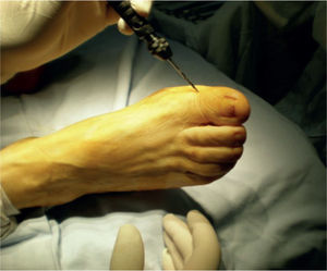 Punto de abordaje de la cirugía de mínima incisión para la corrección del hallux valgus.