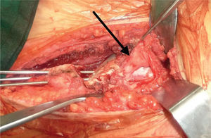 Artrotomía anterior de cadera (flecha) posterior a la osteo tomía periacetabular tipo Ganz.
