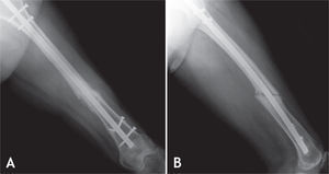 Caso n.°1. No unión manejada con clavo bloqueado, asociada a la fractura de un perno de bloqueo. A. Radiografía anteroposterior. B. Radiografía lateral.