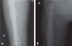 Caso n.° 2. Consolidación luego del manejo con la aumentación con placa antirrotatoria más injertos óseos, sin retiro de los pernos de bloqueo. A: Radiografía anteroposterior. B: Radiografía lateral.