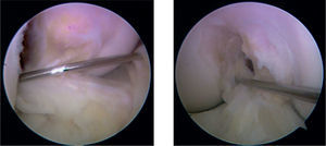 Introducción de la aguja epidural por encima del menisco medial para la colocación del portal medial con el fin de realizar el túnel femoral.