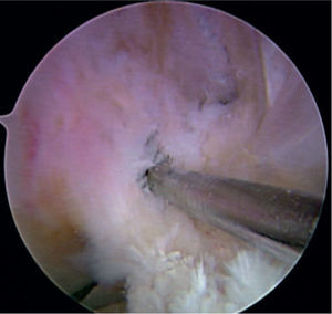 Identificación del centro de la huella femoral, con la rodilla en flexión de 90 grados, y marcación de la misma con una perforación.