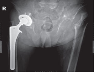 Radiografía AP de pelvis que muestra las secuelas de una fractura subcapital femoral izquierda.