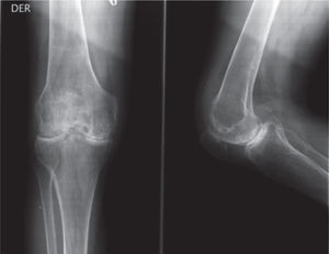 Radiografía de la rodilla derecha, que muestra signos avanzados de artrosis tricompartimental.