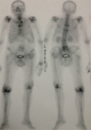 Gammagrafía ósea que muestra hipercaptación en la columna cervical y lumbar, en los hombros y en rodilla derecha.