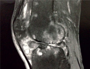 Resonancia magnética de rodilla cuyo reporte sugiere una sinovitis vellonodular pigmentaria.