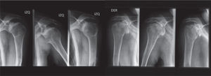 Radiografías que muestran artrosis bilateral de hombros.