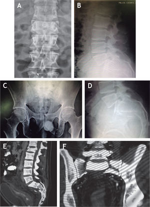 Caso clínico n.° 1. Radiografías AP y lateral de columna lumbosacra (A, B) y de pelvis (C, D) donde se observan la fractura de L1 y la disociación lumbopélvica, confirmadas en las imágenes de tomografía computarizada (E, F).