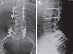 Caso clínico n.° 1. Radiografías AP y lateral, luego de la fijación lumbopélvica.